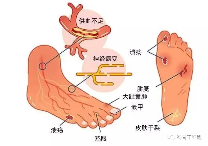 糖尿病足“截肢噩梦”将终结？细胞疗法让80%患者伤口完全愈合！