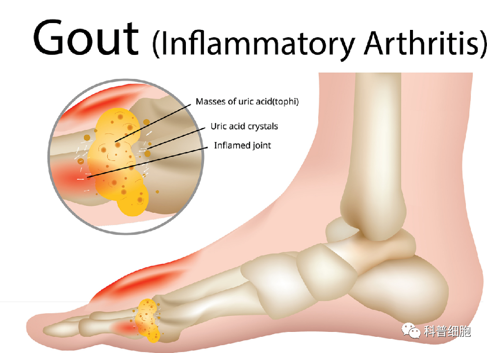 痛风，一场“重塑”人类历史的疾病，干细胞带来新希望！