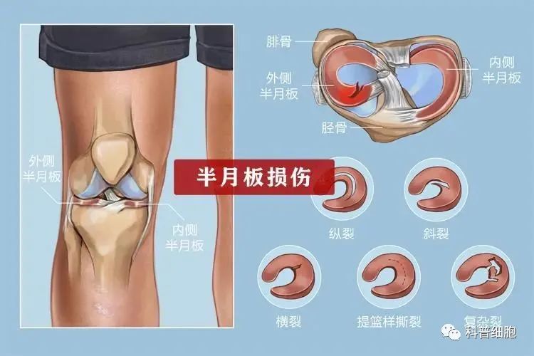 干细胞技术干预半月板损伤临床效果显著-这以是公认的有效手段之一