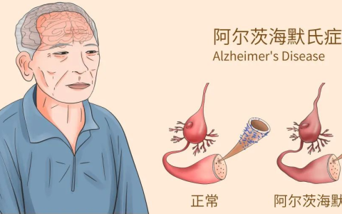 全球首次：瑞金医院干细胞外泌鼻喷阿尔茨海默症，12周疗效揭示，优于传统药物！