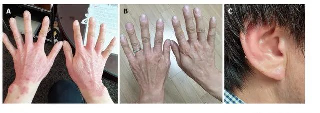 3次干细胞治疗后，25年的银屑病红斑基本消退，且5个月未见复发