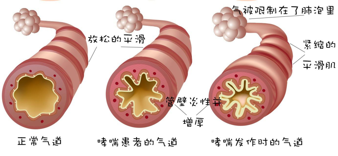 从呼吸困难到自由呼吸：干细胞改变68岁哮喘患者命运