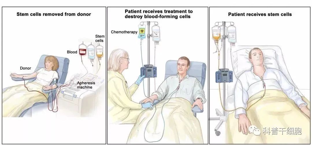 科普|自体VS异体干细胞回输，疑问一网打尽！