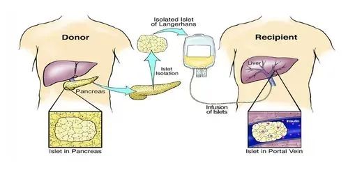 间充质干细胞在 1 型糖尿病胰岛移植中的临床进展