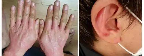 3次干细胞治疗后，25年的银屑病红斑基本消退，且5个月未见复发