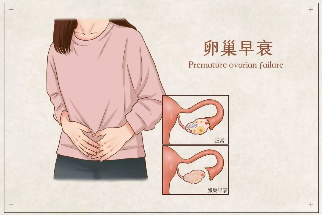 4个关于卵巢早衰的临床案例 :值得被期待的干细胞技术