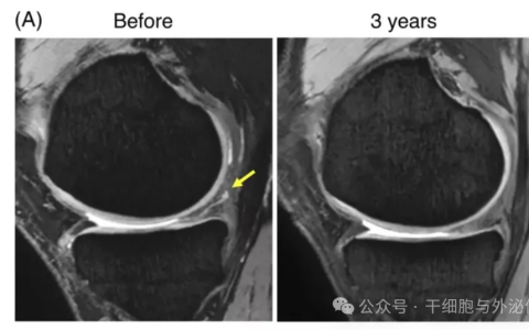 5年随访证明：间充质干细胞对慢性膝关节疼痛有显著疗效