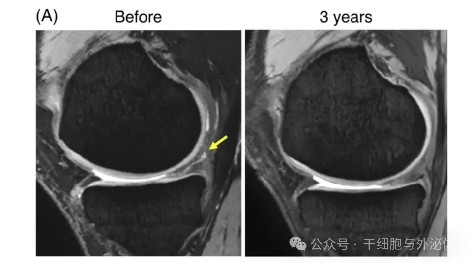5年随访证明：间充质干细胞对慢性膝关节疼痛有显著疗效