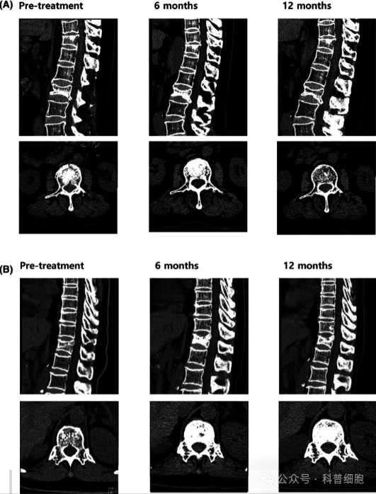 干细胞治疗分泌系统:糖尿病、甲减、骨质疏松症……临床案例