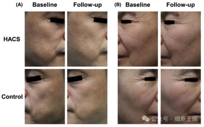 干细胞写入抗衰专家共识！基于细胞学干预皮肤衰老的浪潮正在兴起