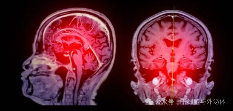 592名患者，13项临床研究证实：干细胞可降低缺血性中风的死亡率