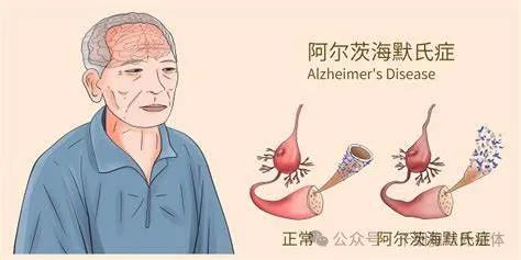 83例证明：输注间充质干细胞老年痴呆患者记忆和认识能力有效改善