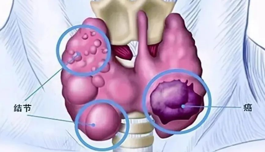 改善甲状腺健康，免疫细胞疗法来帮忙！