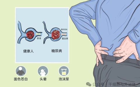干细胞治疗糖尿病肾病30例疗效显著