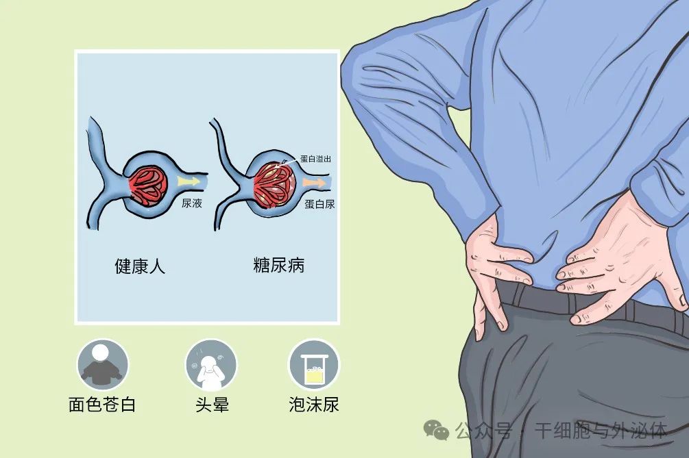 干细胞治疗糖尿病肾病30例疗效显著