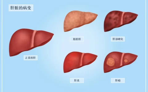 历经7年，108名肝硬化患者接受干细胞治疗，临床症状显著缓解