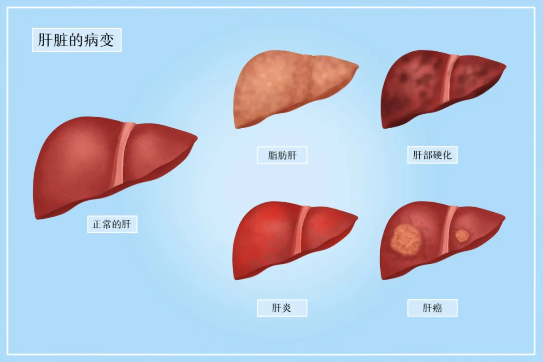 历经7年，108名肝硬化患者接受干细胞治疗，临床症状显著缓解