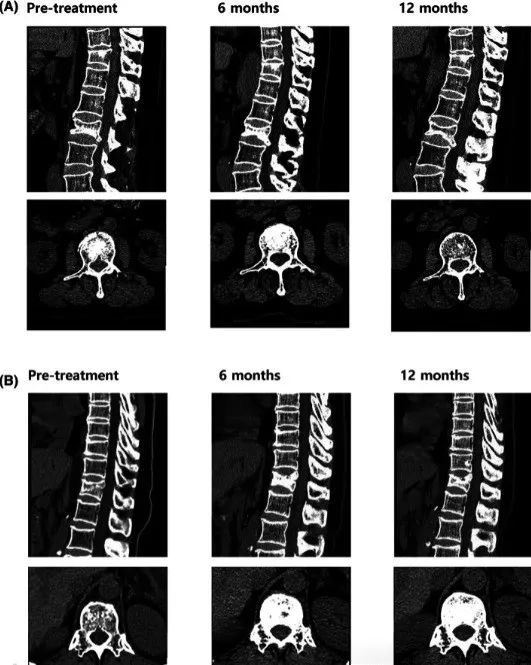 临床案例分析：干细胞治疗糖尿病、甲减、骨质疏松症