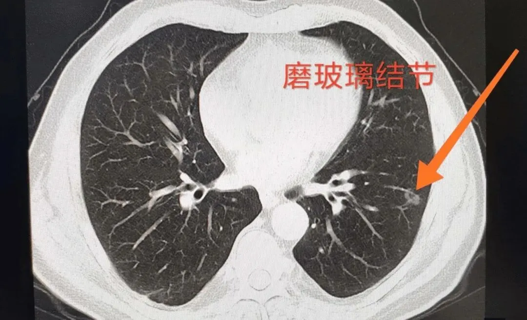 细胞疗法上演肺结节“消失术”，从根源扼杀一切可能的病变