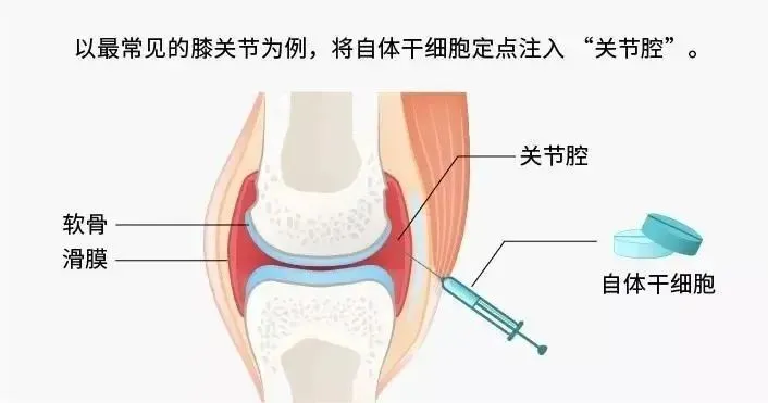 5年随访证实：干细胞治疗慢性膝关节疼痛安全有效