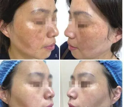 水光针VS外泌体:诺贝尔奖加持的“外泌体”为何能在医美界火爆出圈?